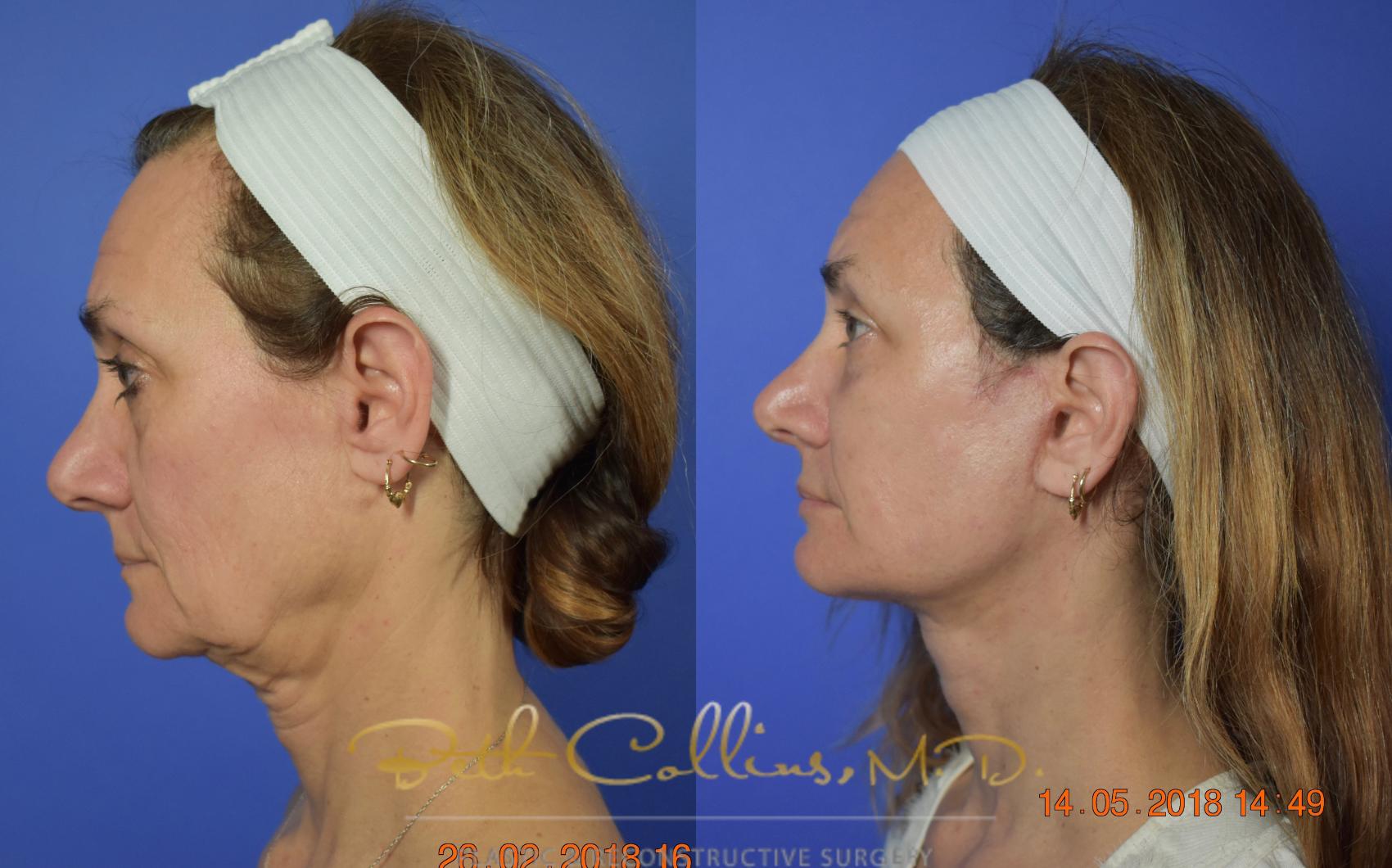 Facelift Case 106 Before & After View #2 | Guilford, CT | Beth Collins M.D.