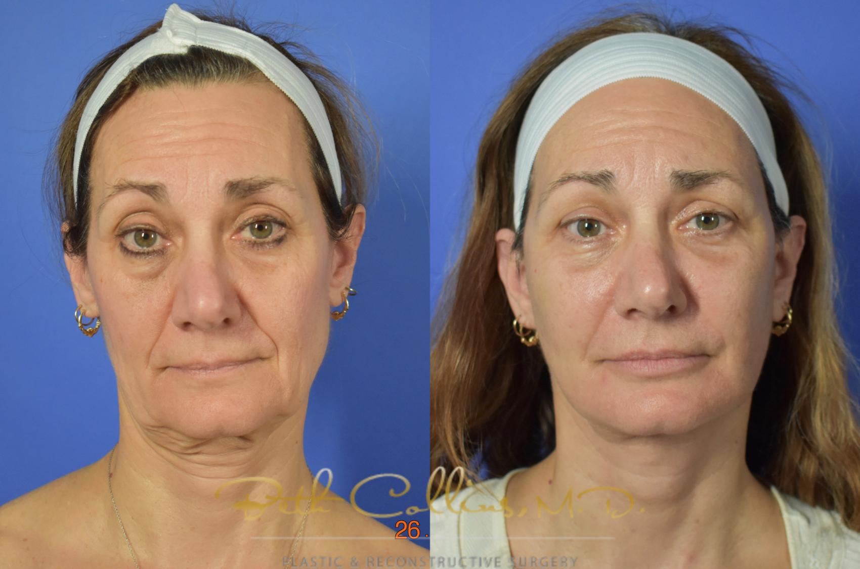 Facelift Case 106 Before & After View #3 | Guilford, CT | Beth Collins M.D.