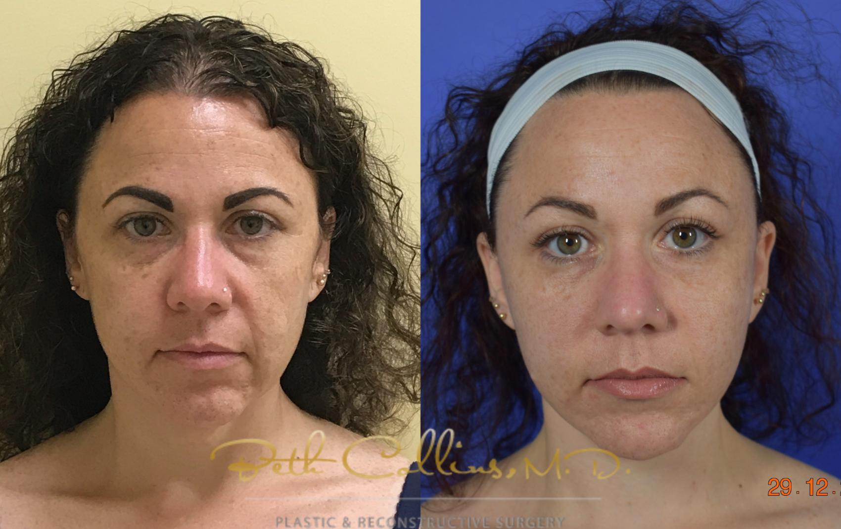 Facelift Case 107 Before & After View #1 | Guilford, CT | Beth Collins M.D.