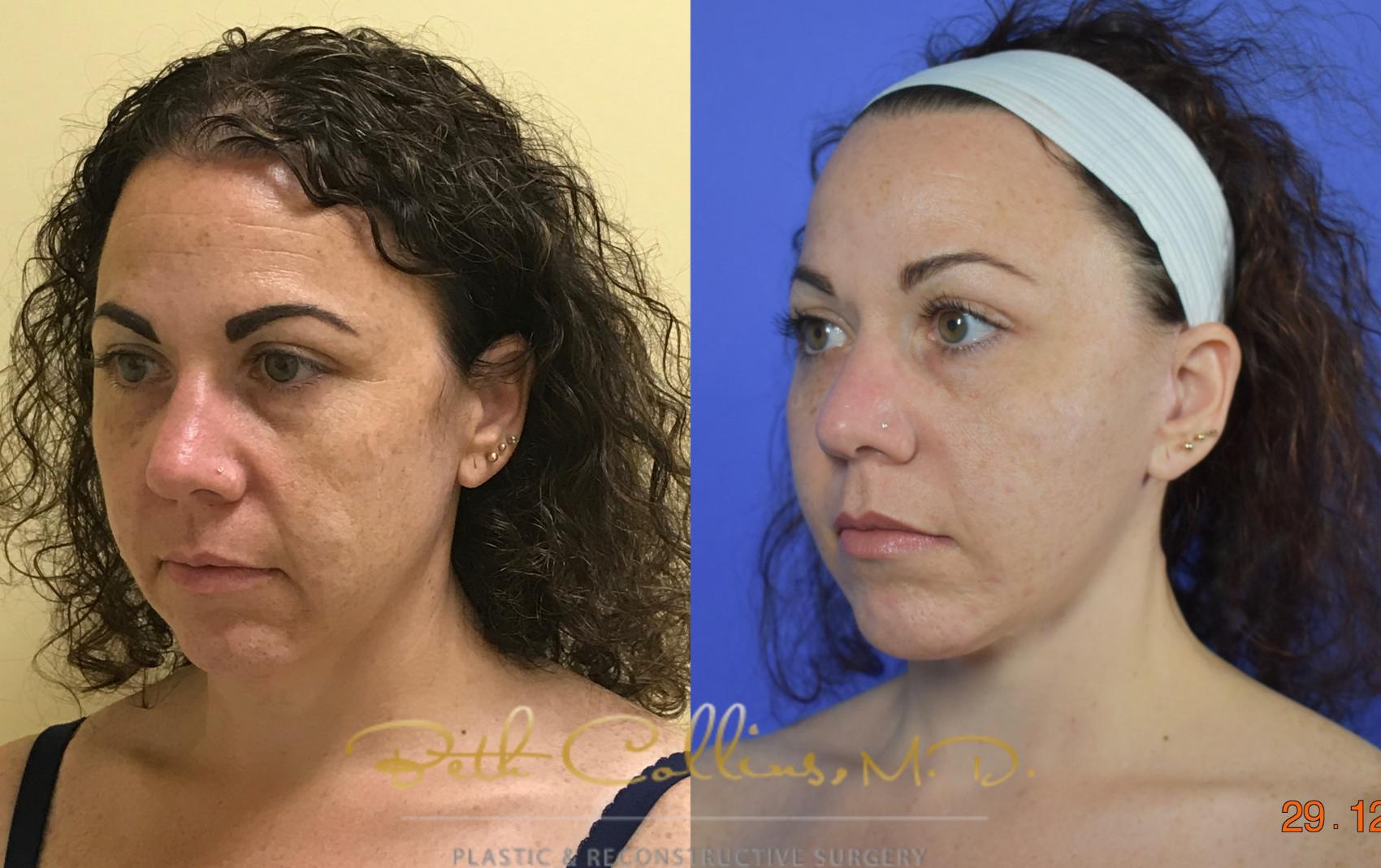 Before & After Facelift Case 107 View #2 View in Guilford, CT
