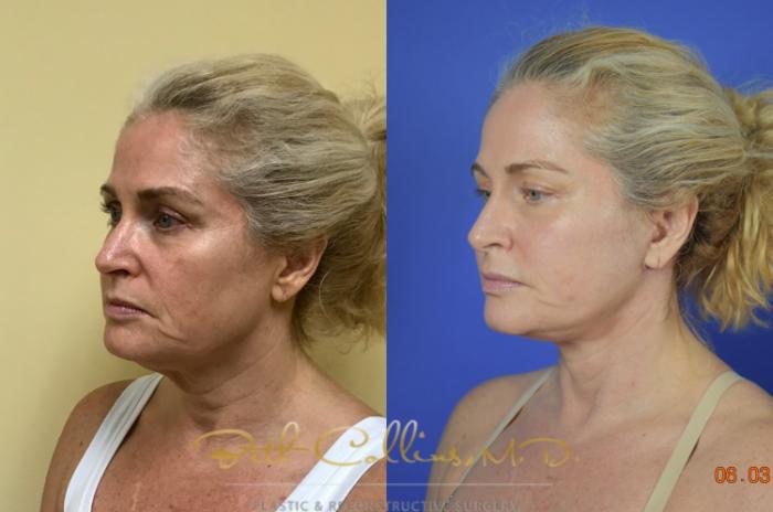 Before & After Facelift Case 118 View #4 View in Guilford, CT