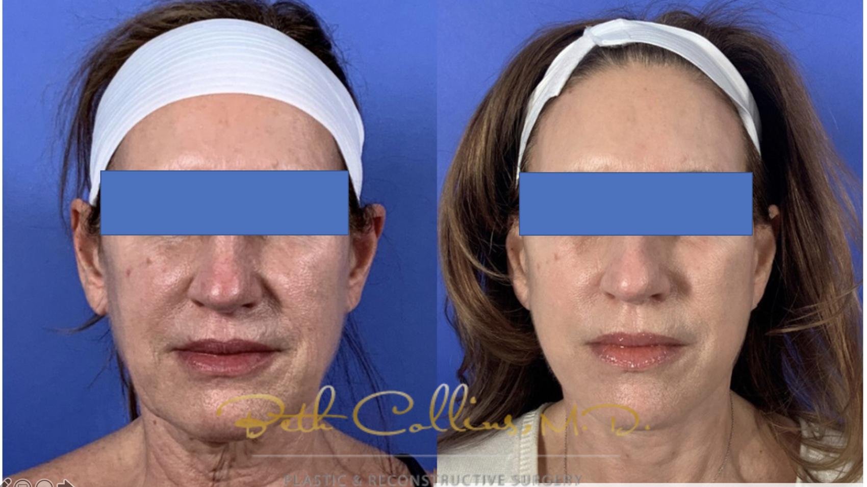 Facelift Case 135 Before & After Front | Guilford, CT | Beth Collins M.D.