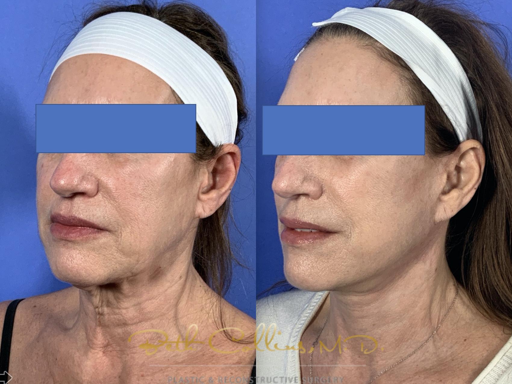 Facelift Case 135 Before & After Left Oblique | Guilford, CT | Beth Collins M.D.