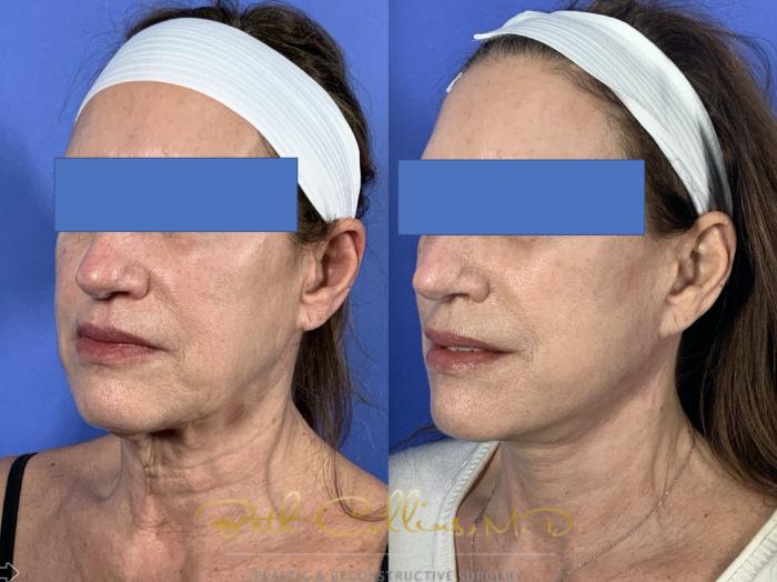 Before & After Facelift Case 135 Left Oblique View in Guilford, CT