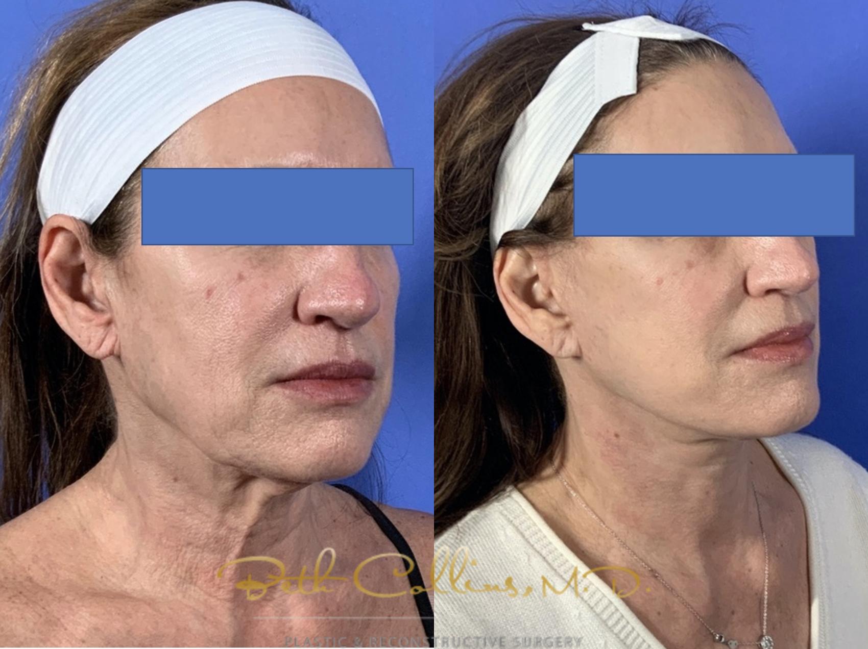 Facelift Case 135 Before & After Right Oblique | Guilford, CT | Beth Collins M.D.