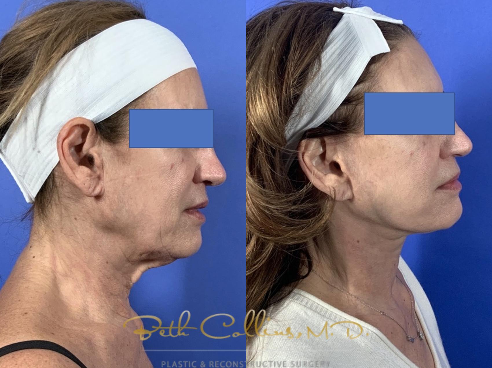 Facelift Case 135 Before & After Right Side | Guilford, CT | Beth Collins M.D.