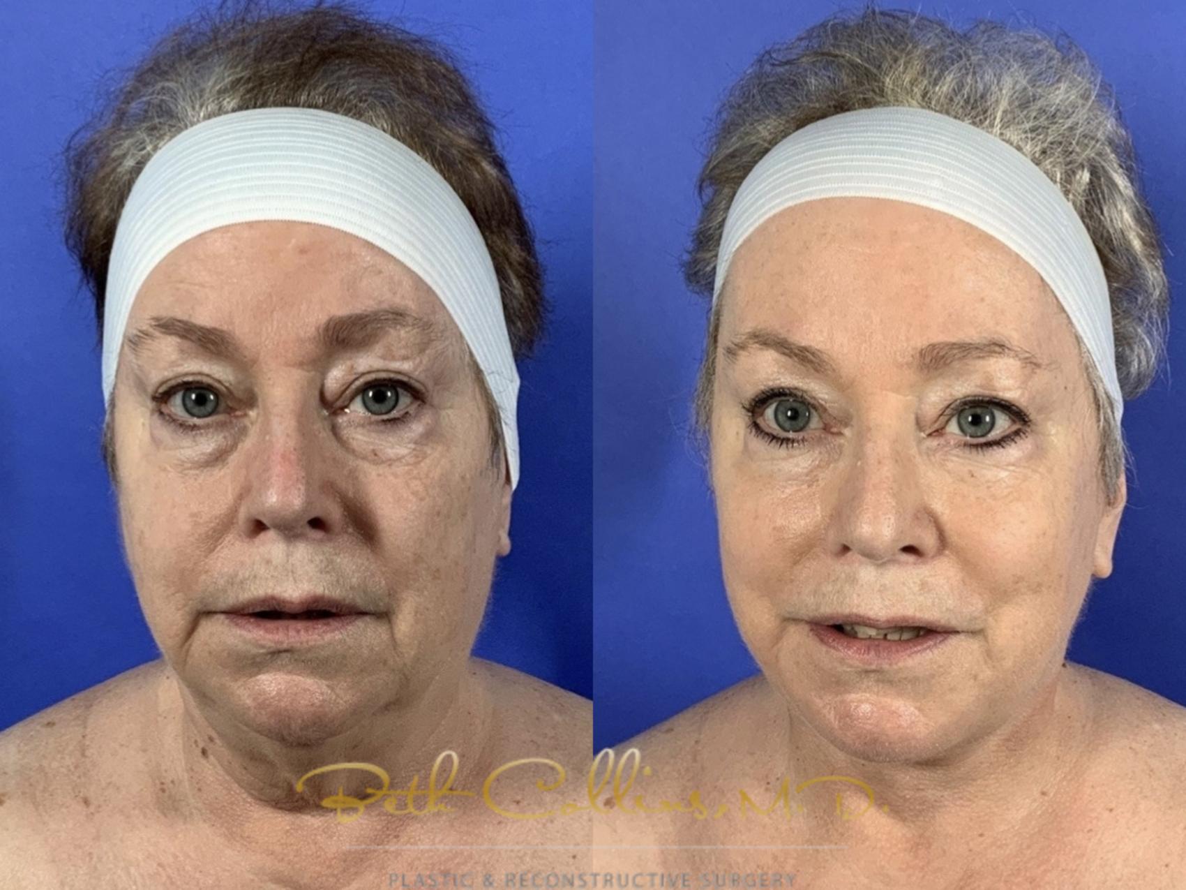 Deep Plane Neck Contouring