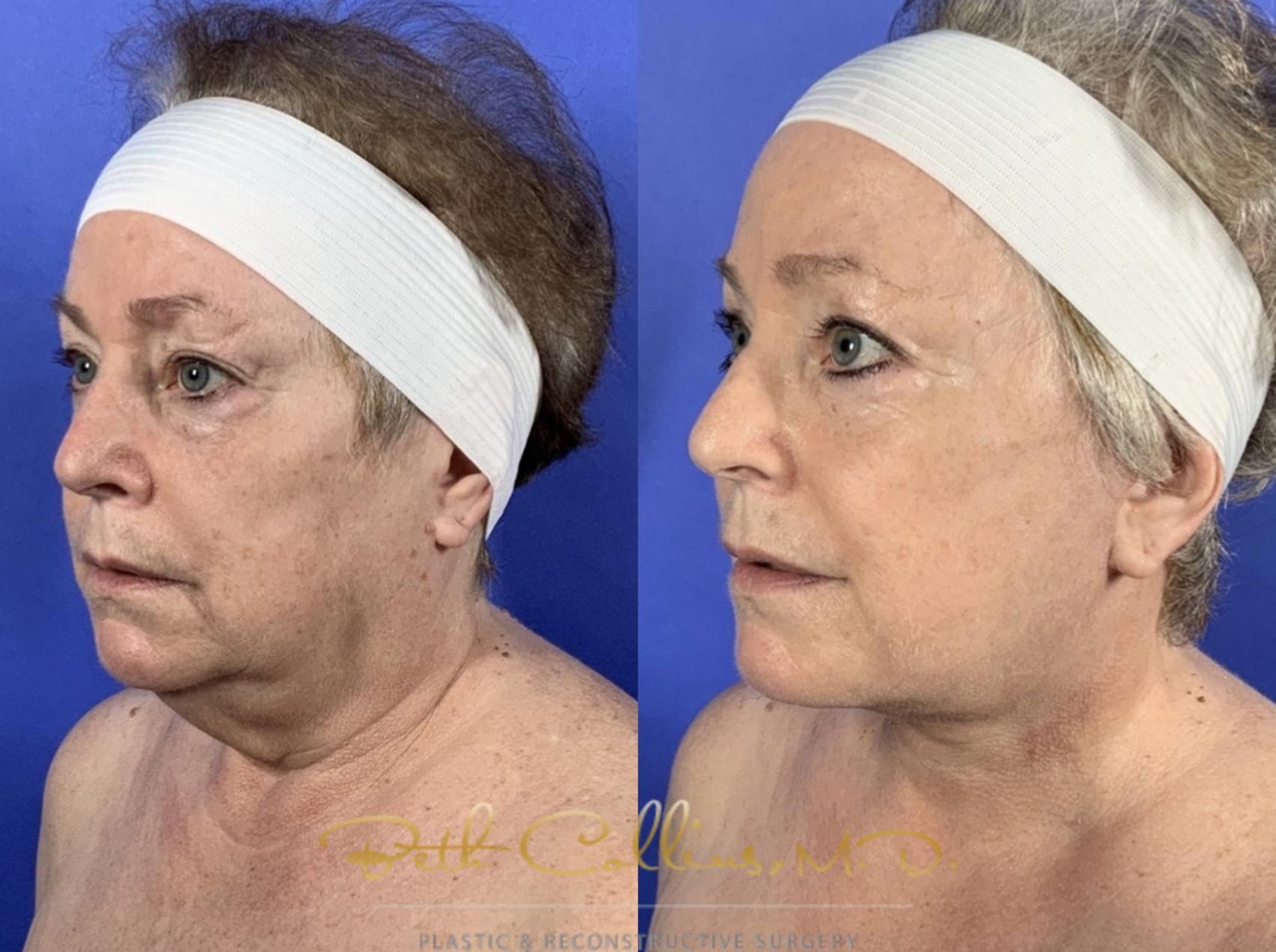 Before & After Facelift Case 136 Left Oblique View in Guilford, CT