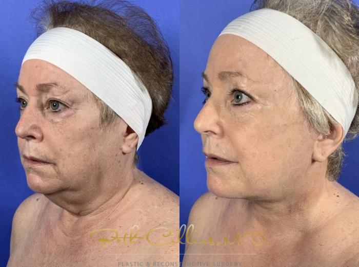 Before & After Facelift Case 136 Left Oblique View in Guilford, CT