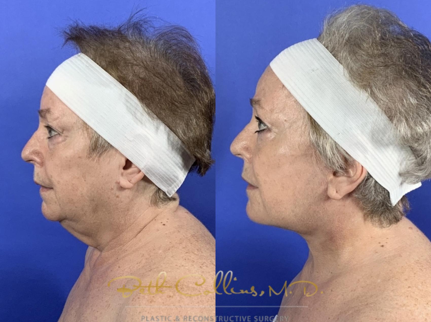 Before & After Facelift Case 136 Left Side View in Guilford, CT