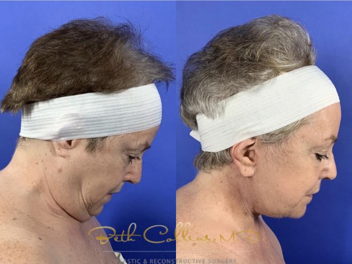 Before & After Facelift Case 136 Right downward Gaze View in Guilford, CT