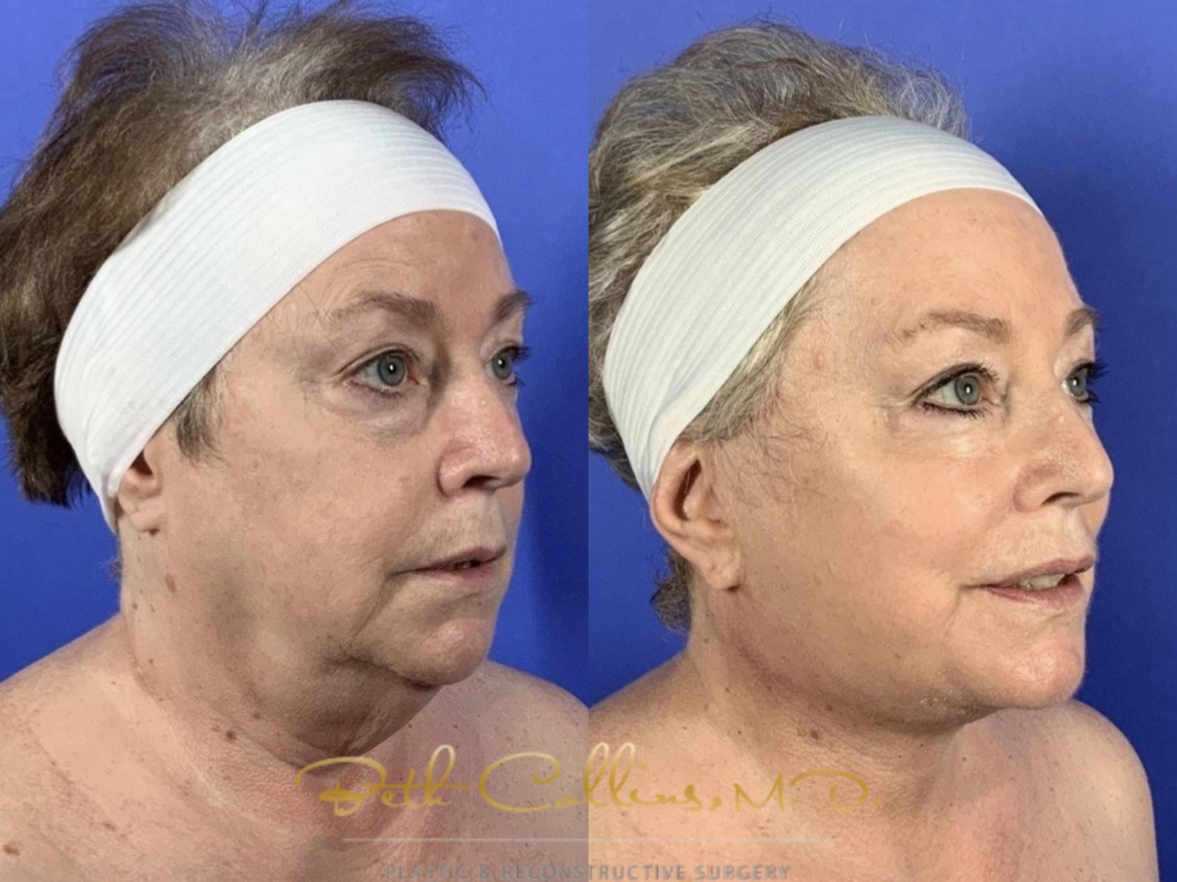 Before & After Facelift Case 136 Right Oblique View in Guilford, CT