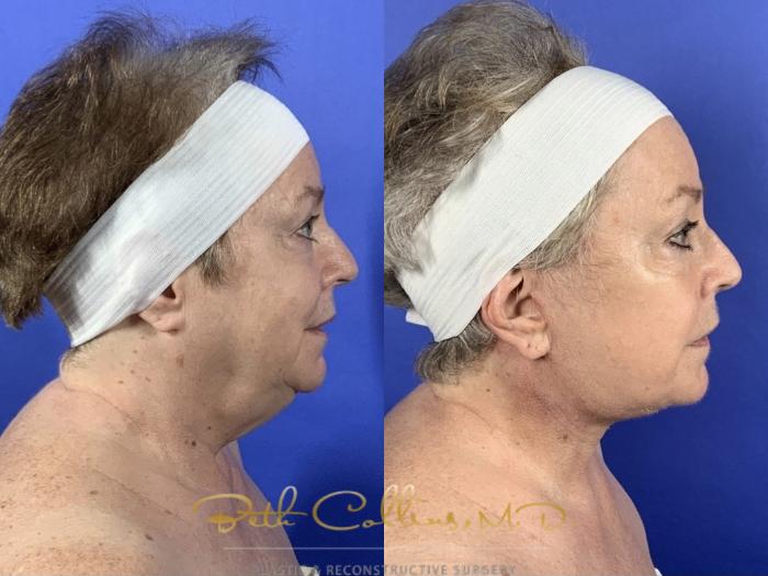 Before & After Facelift Case 136 Right Side View in Guilford, CT