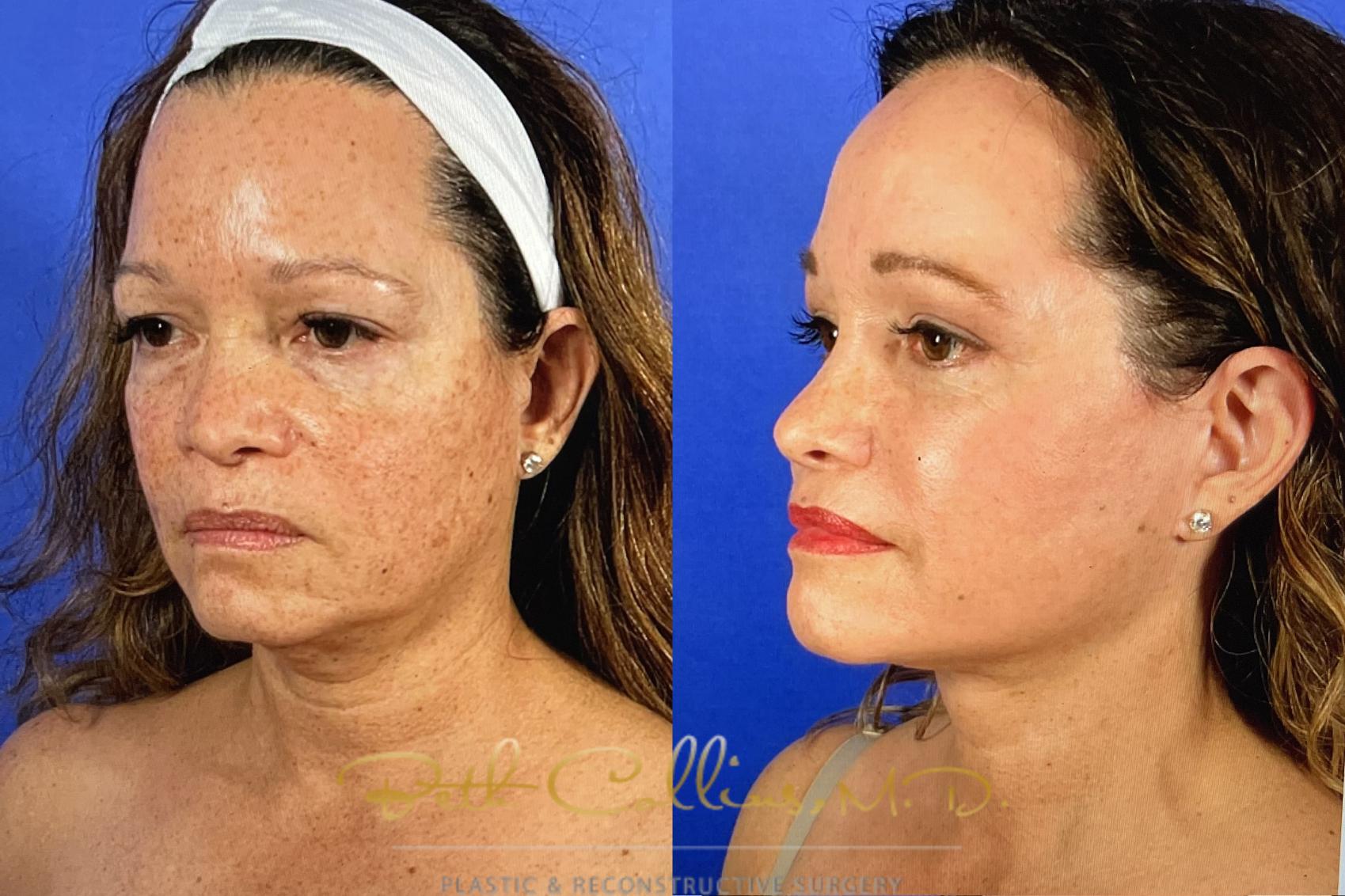 Before & After Facelift Case 147 Left Oblique View in Guilford, CT