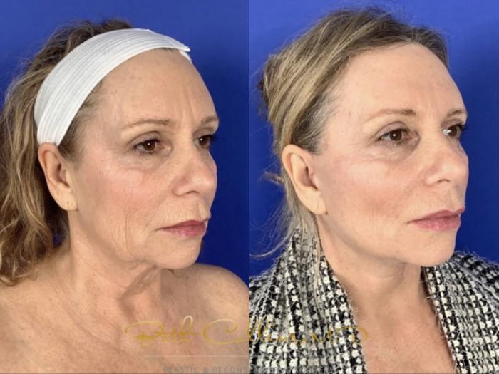 Lower face and neck lift