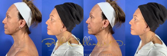 Lower face and neck lift with lower lid blepharoplasty