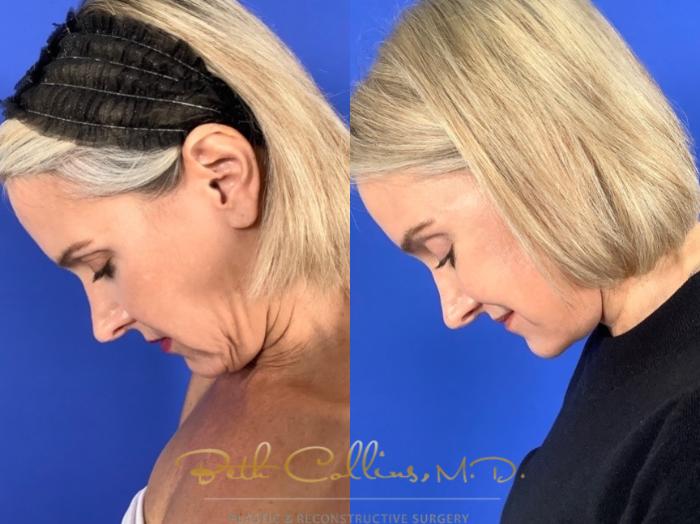 Before & After Facelift Case 241 Side view downward gaze left View in Guilford, CT