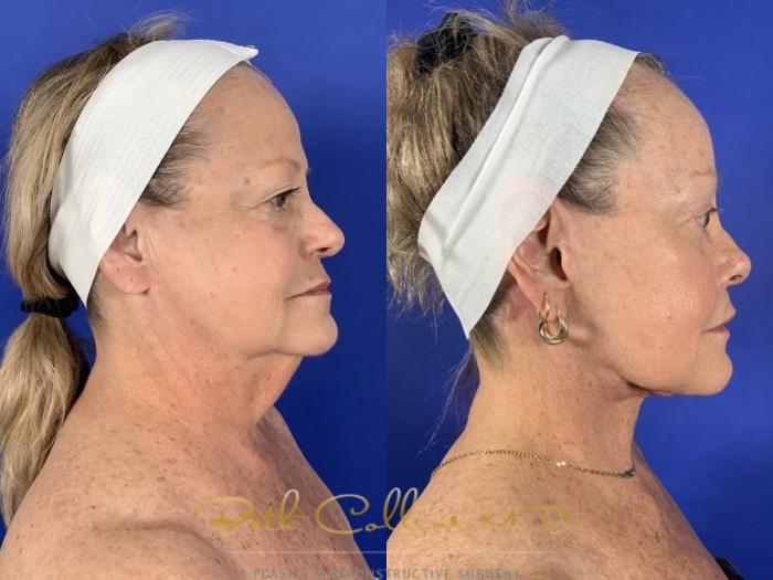 Deep plane facelift with endoscopic brow lift, upper and lower lid blepharoplasty, upper lip lift and facial fat grafting