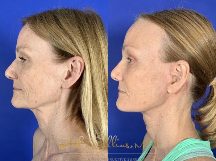 Lower face and neck lift with brow lift and upper lid blepharoplasty
