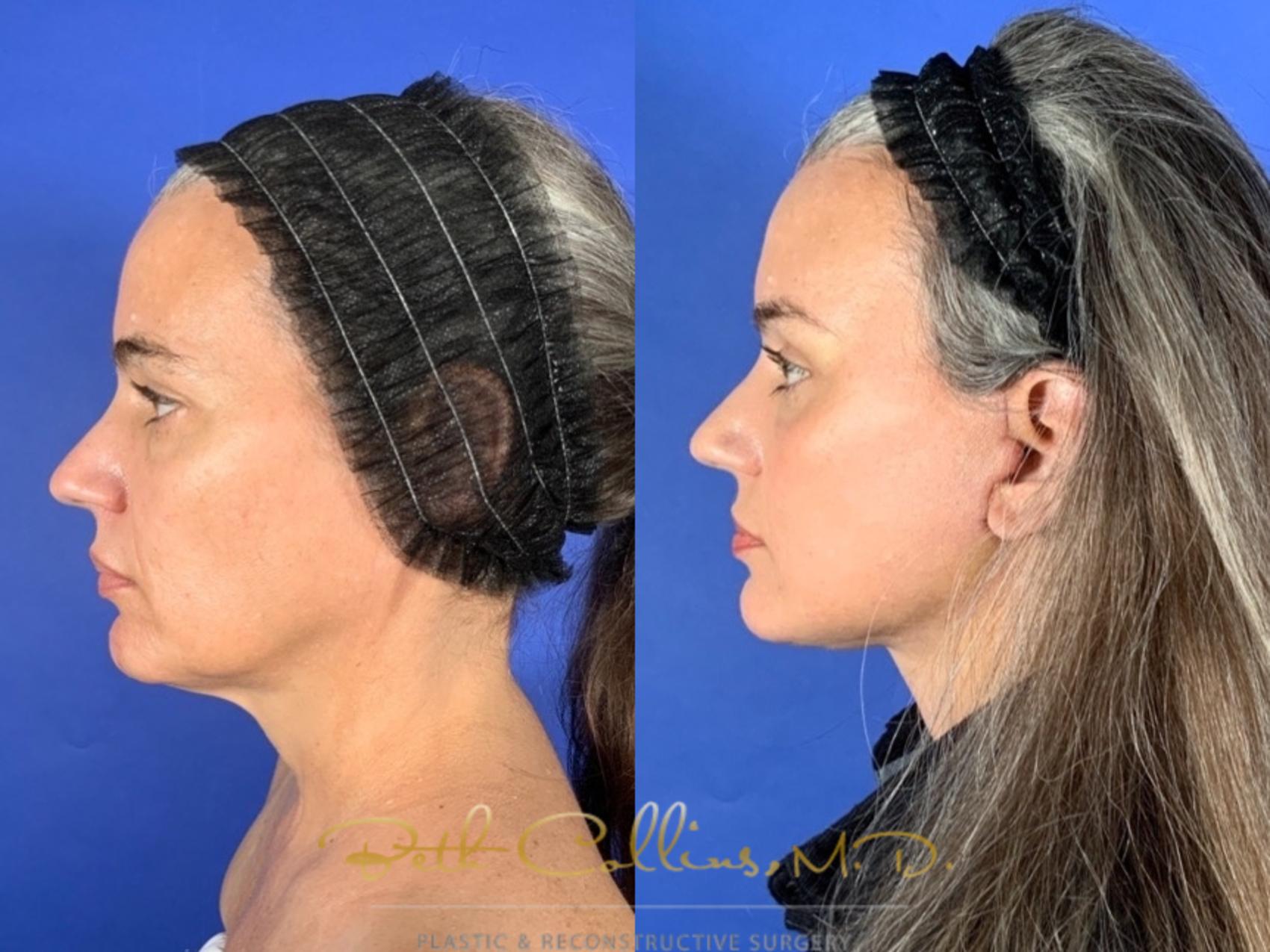 Deep plane facelift with endoscopic brow lift