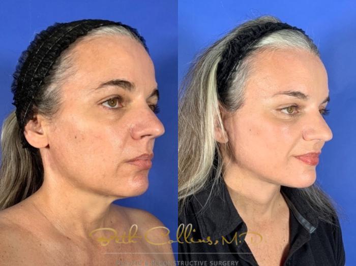 Deep plane facelift with endoscopic brow lift