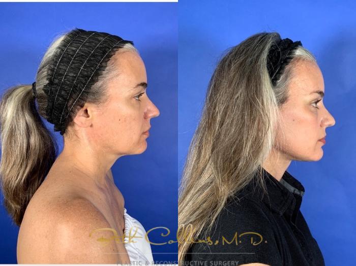 Deep plane facelift with endoscopic brow lift