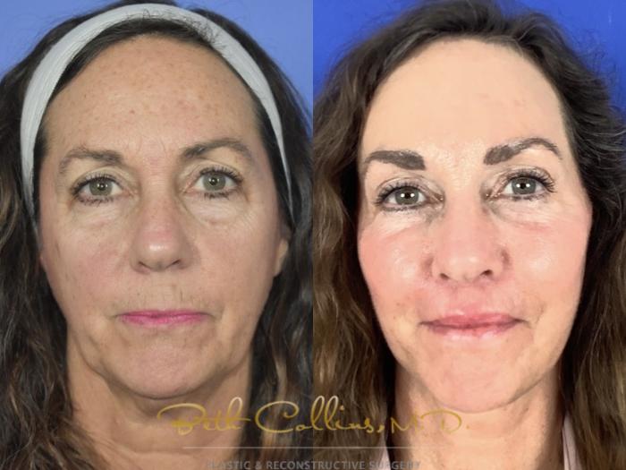 deep plane facelift with endoscopic brow lift, upper and lower lid blepharoplasty, upper lip lift and facial fat grafting