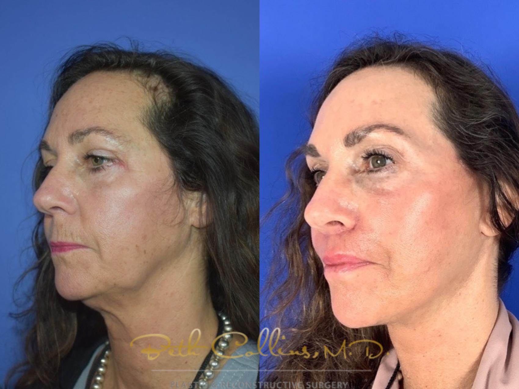 Deep plane facelift with endoscopic brow lift, upper and lower lid