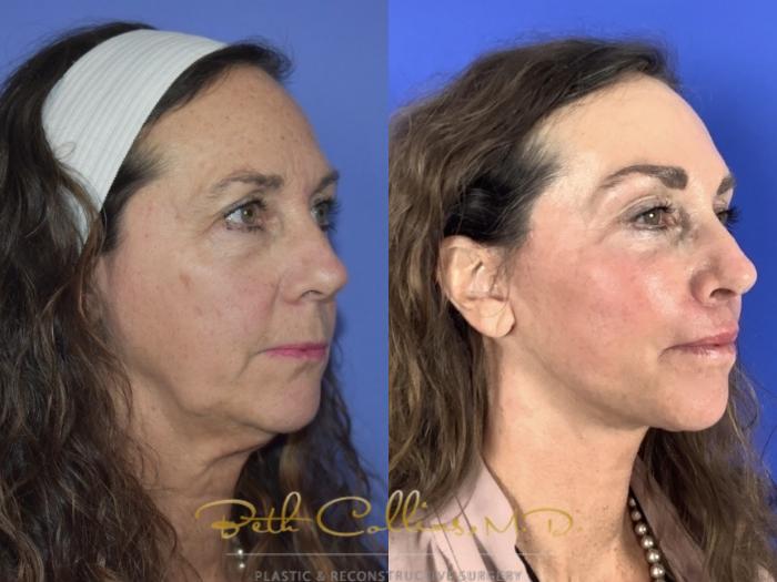 Deep plane facelift with endoscopic brow lift, upper and lower lid blepharoplasty, upper lip lift and facial fat grafting