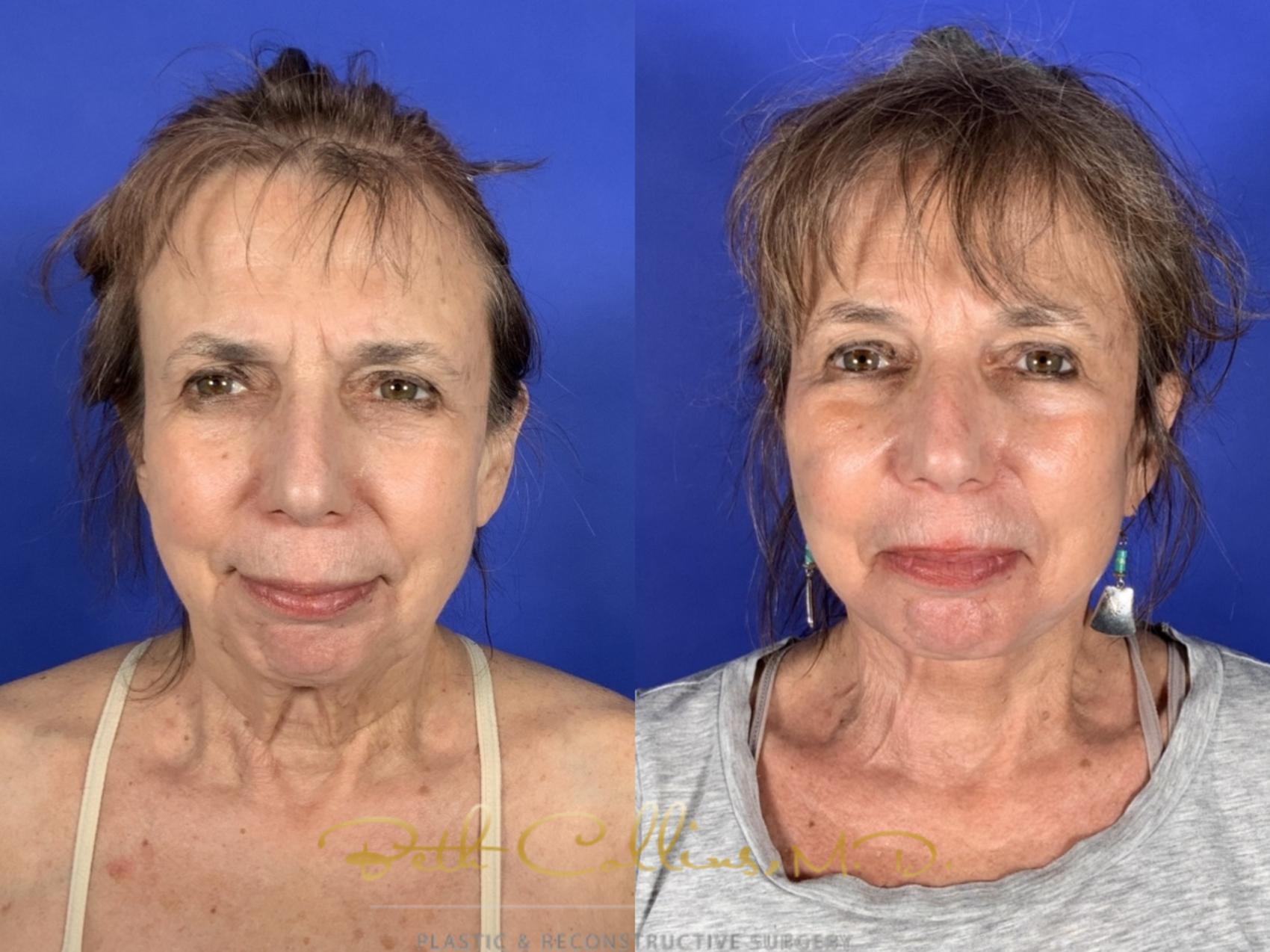 Before & After Facelift Case 253 Front View in Guilford, CT