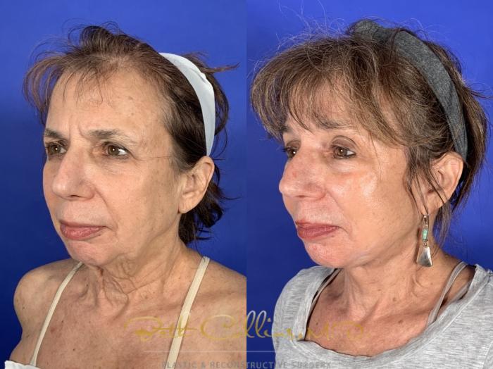 Before & After Facelift Case 253 Left Oblique View in Guilford, CT