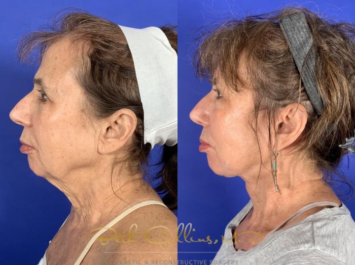 Before & After Facelift Case 253 Left Side View in Guilford, CT