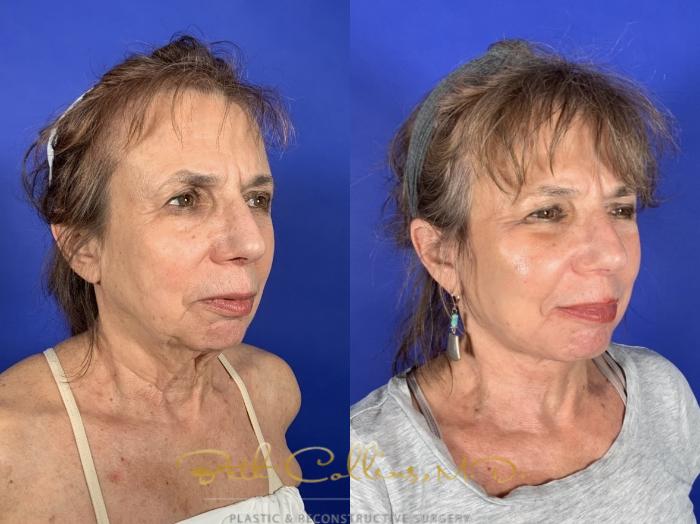 Before & After Facelift Case 253 Right Oblique View in Guilford, CT