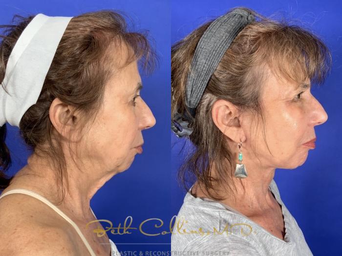 Before & After Facelift Case 253 Right Side View in Guilford, CT