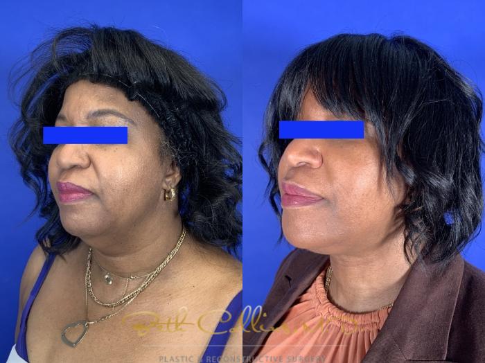 Before & After Facelift Case 254 Left Oblique View in Guilford, CT