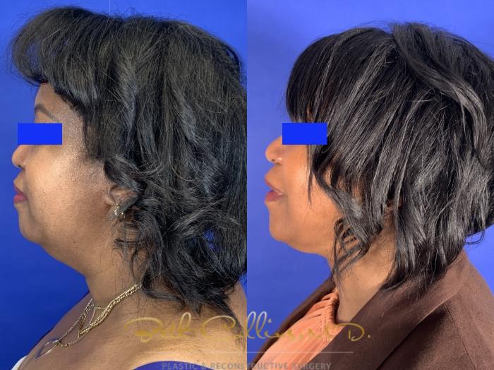 Before & After Facelift Case 254 Left Side View in Guilford, CT