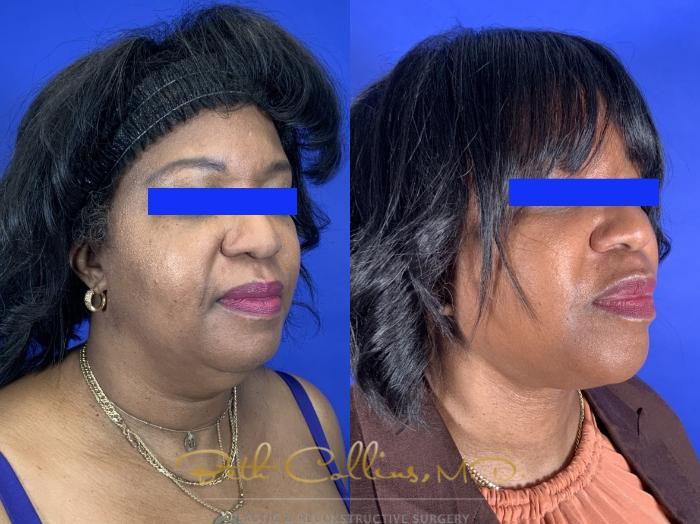 Before & After Facelift Case 254 Right Oblique View in Guilford, CT