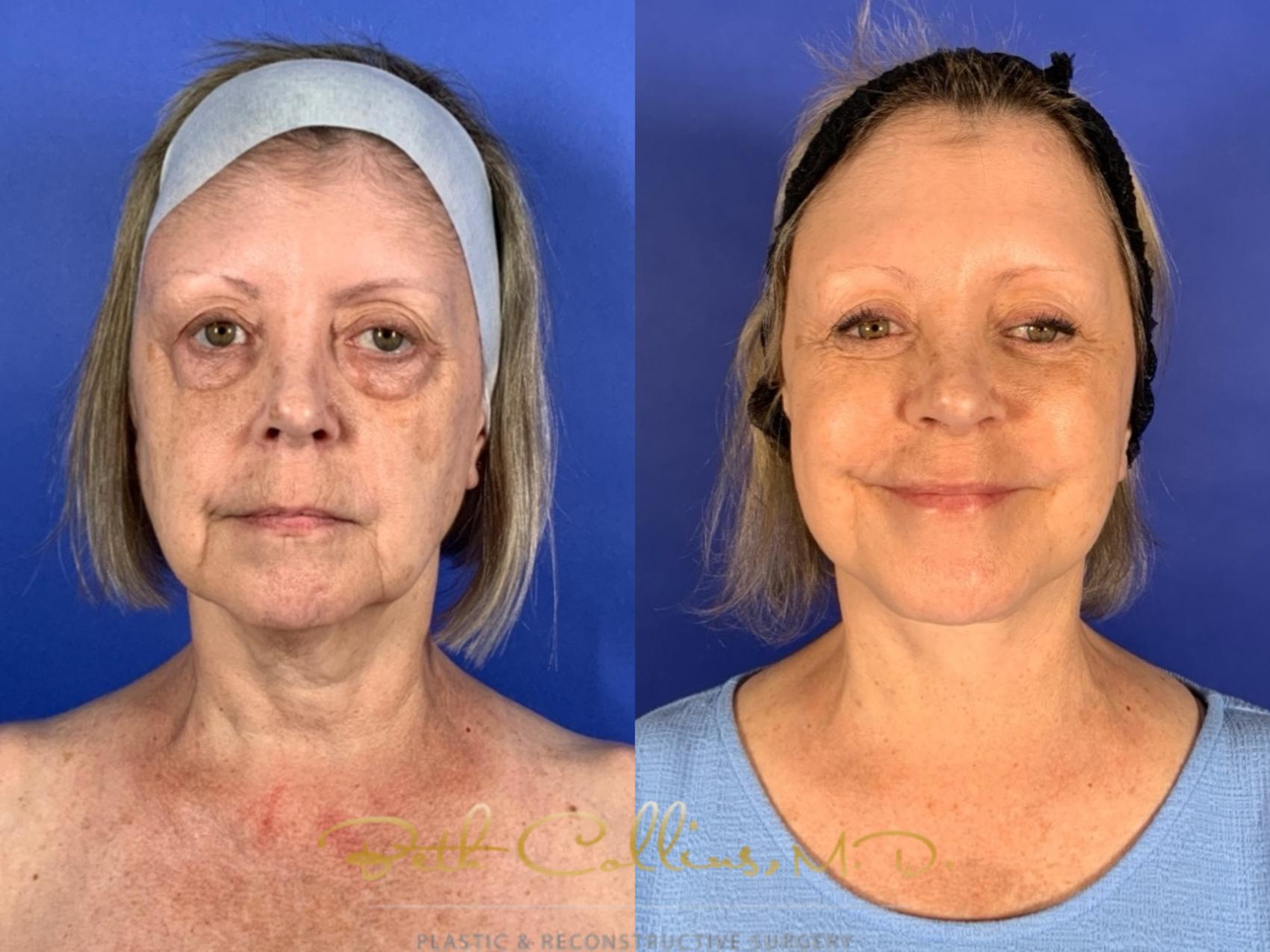 Before & After Facelift Case 255 Front View in Guilford, CT