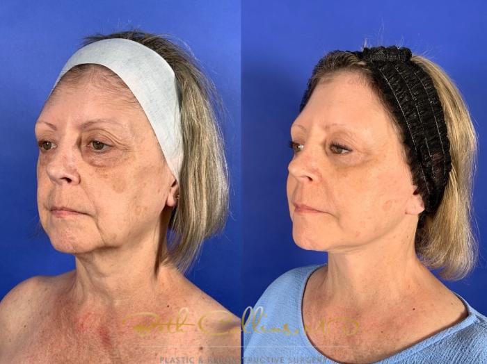 Before & After Facelift Case 255 Left Oblique View in Guilford, CT