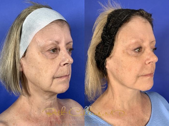 Before & After Facelift Case 255 Right Oblique View in Guilford, CT