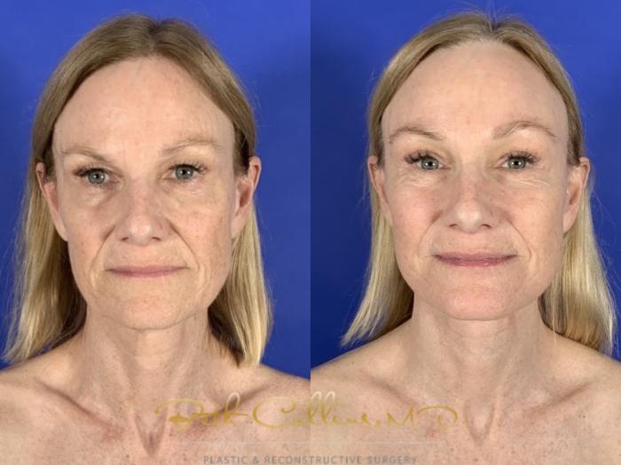 Before & After Facelift Case 256 Front View in Guilford, CT
