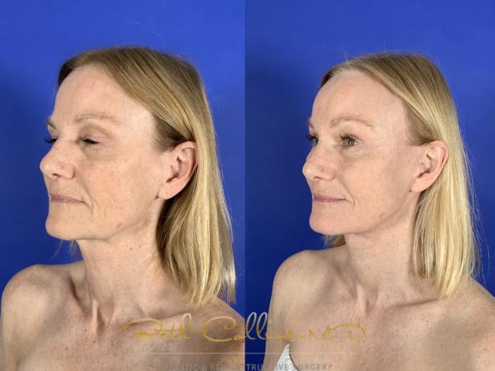 Before & After Facelift Case 256 Left Oblique View in Guilford, CT