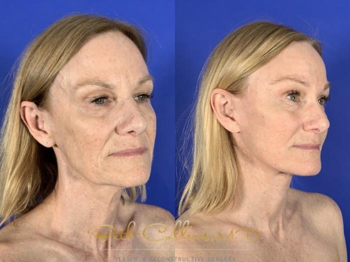 Before & After Facelift Case 256 Right Oblique View in Guilford, CT