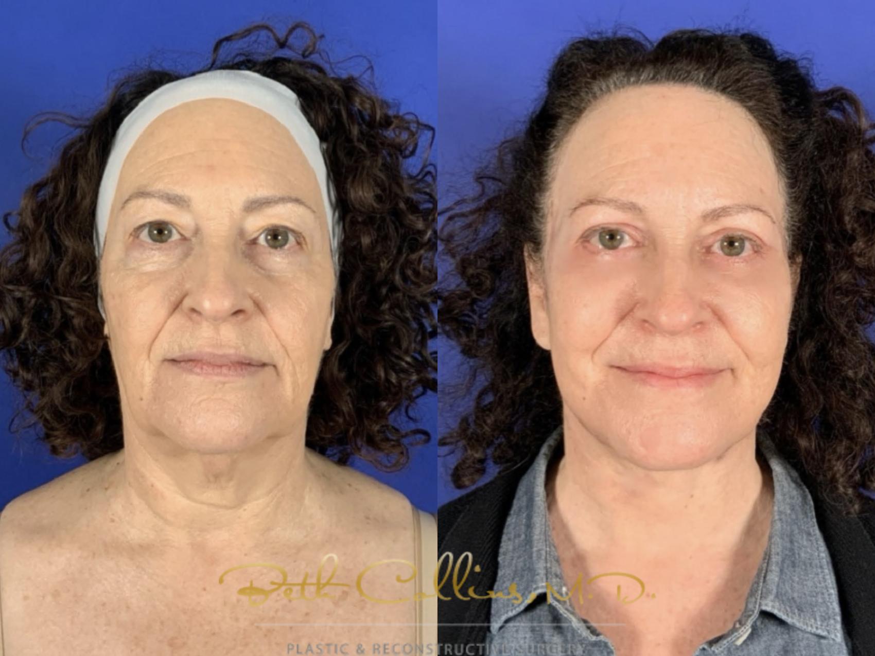 Before & After Facelift Case 257 Front View in Guilford, CT