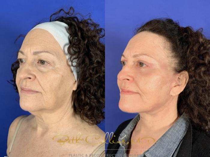 Before & After Facelift Case 257 Left Oblique View in Guilford, CT