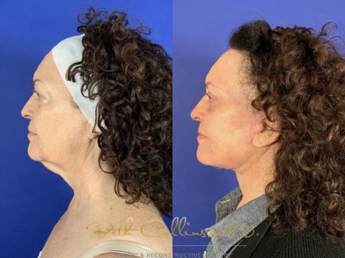 Before & After Facelift Case 257 Left Side View in Guilford, CT