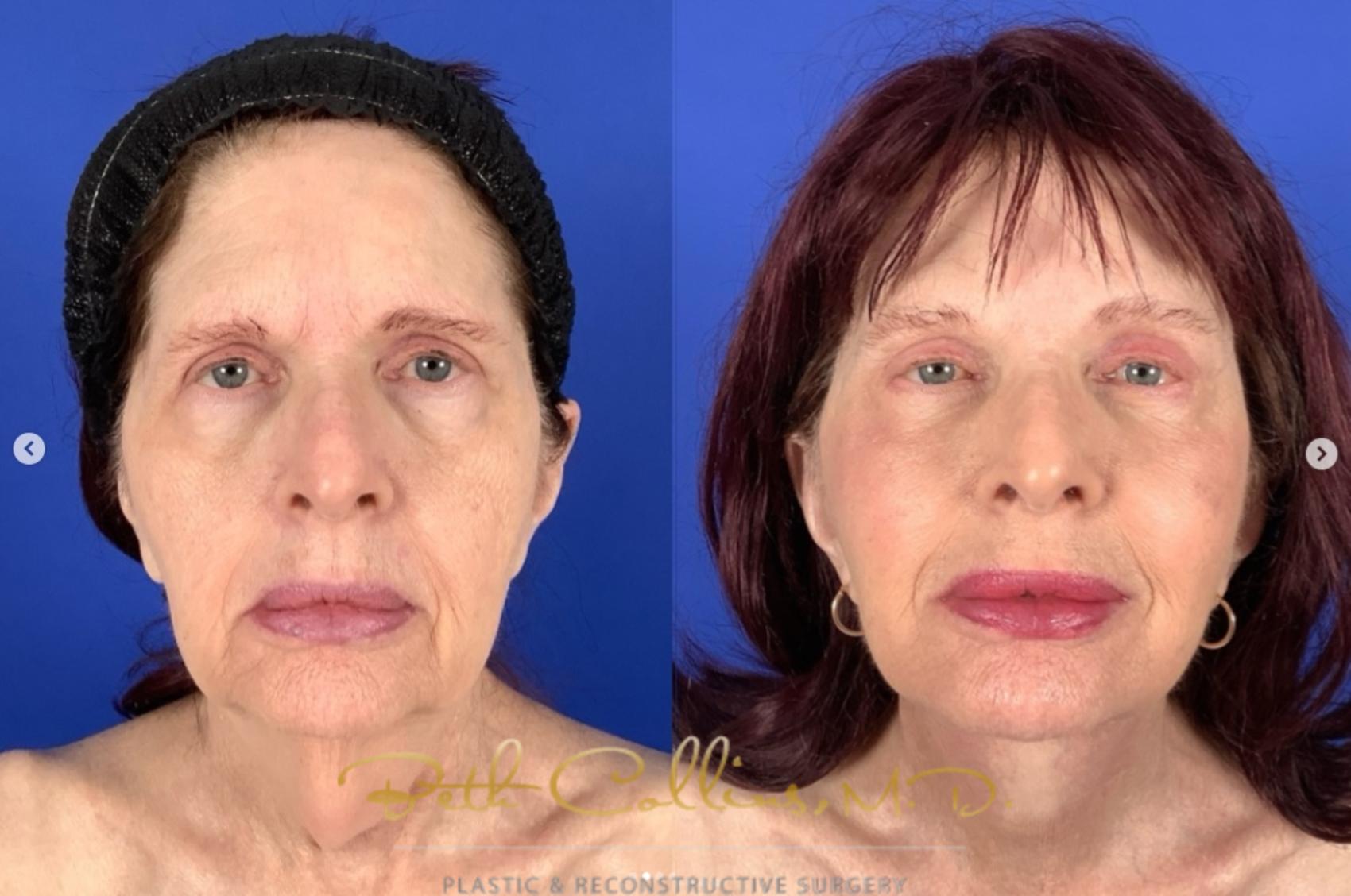 Before & After Neck Lift Case 265 Front View in Guilford, CT