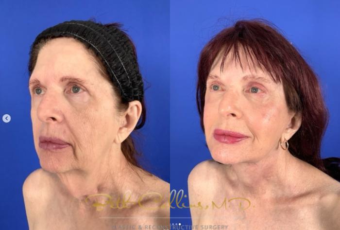 Before & After Facelift Case 265 Left Oblique View in Guilford, CT