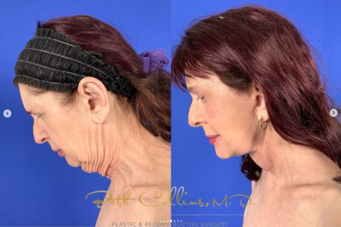 Before & After Neck Liposuction Case 265 Left Side - Head Bent View in Guilford, CT