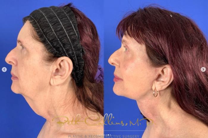 Before & After Facelift Case 265 Left Side View in Guilford, CT